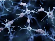 Phát triển xét nghiệm máu cho bệnh Alzheimer