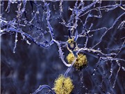 FDA phê duyệt thuốc điều trị Alzheimer thứ hai