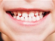 Triển vọng thuốc giúp răng mọc lại