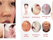 Thử nghiệm nhóm steroid trong mỹ phẩm