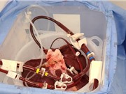 Thử nghiệm dùng gan lợn để lọc máu từ bên ngoài cơ thể