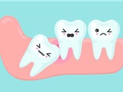 Câu chuyện đằng sau chiếc răng khôn