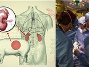 Ca ghép thận lợn đầu tiên ở người