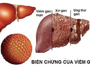 Số ca tử vong do viêm gan virus ngày càng tăng