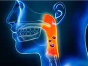 Xu hướng các bệnh ung thư vùng đầu và cổ ở TP HCM 