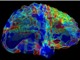 Một gene mạnh làm tăng nguy cơ mắc bệnh Alzheimer, Parkinson và các bệnh về não khác