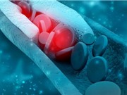 Ngăn chặn tích tụ cholesterol bằng cách vô hiệu hóa enzyme